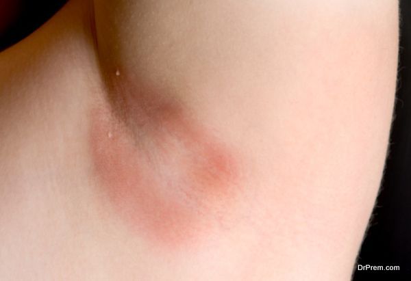 A persons armpit afflicted with a yeast infection.