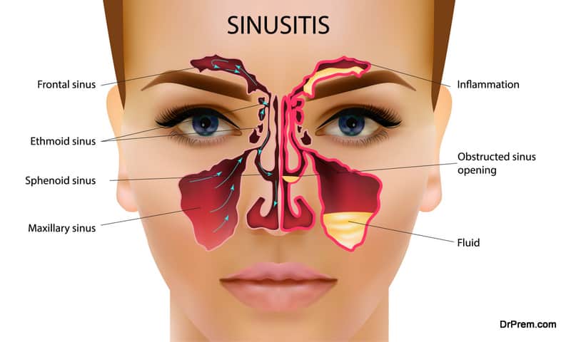 Sinusitis. Healthy and inflammation nasal sinus