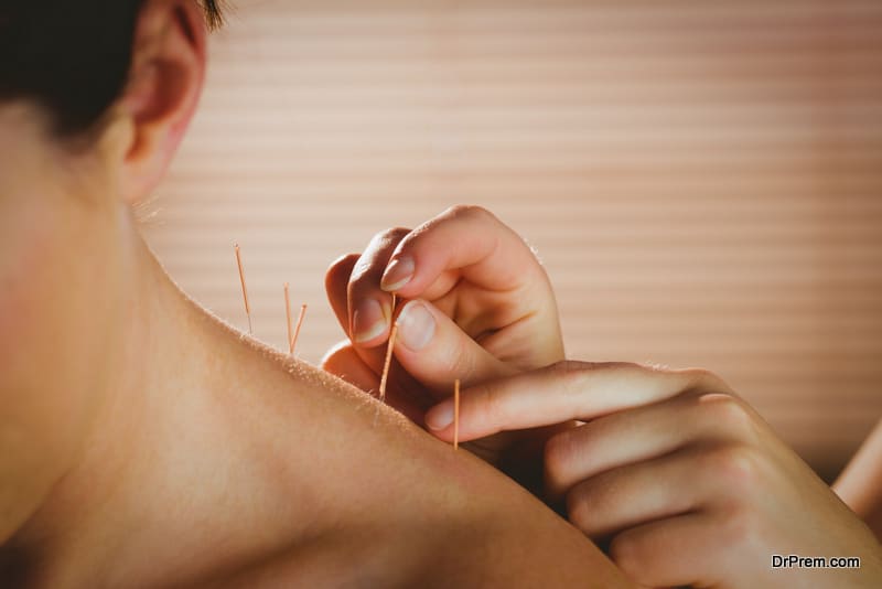 Young woman getting acupuncture treatment in therapy room