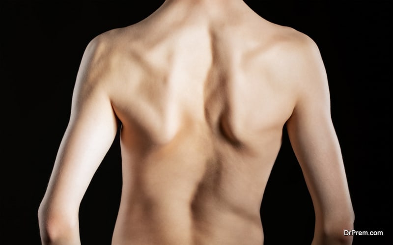 A young man with a severe curvature of the spine