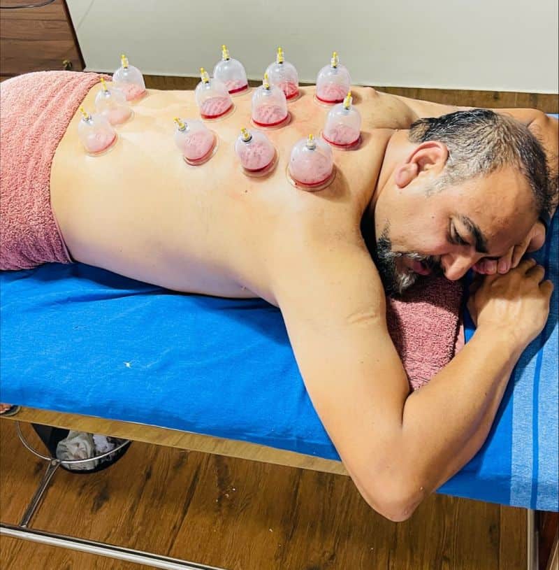 Dr Prem adopted Cupping therapy