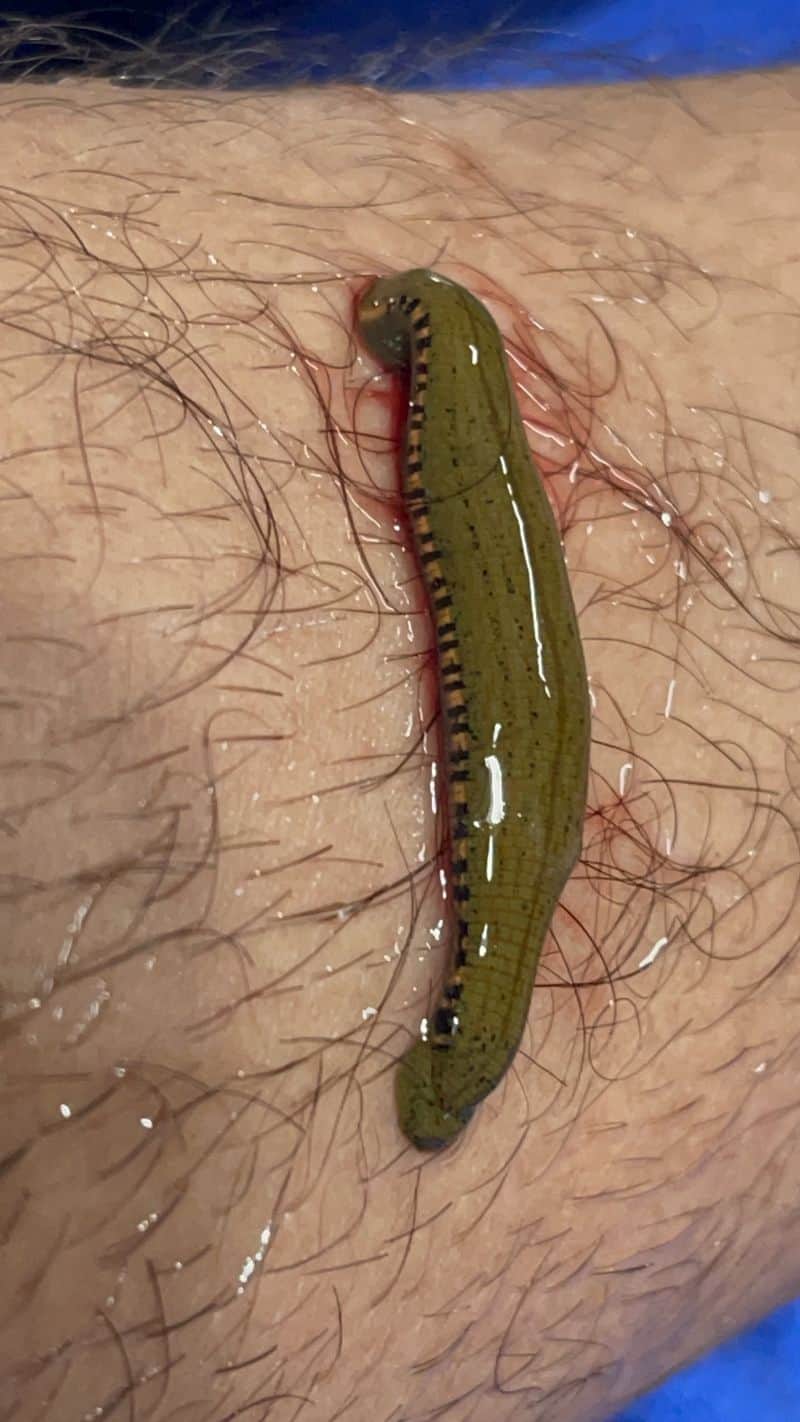 Dr Prem's Leech Therapy experience