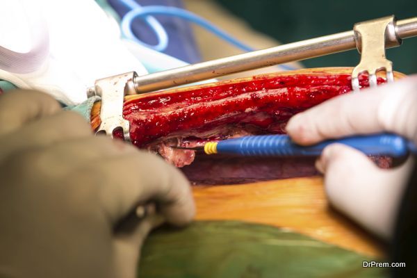 Surgery for Coronary Artery Bypass