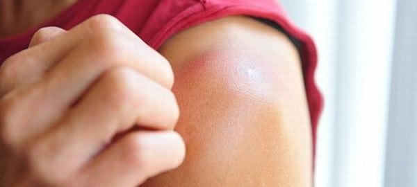 Protect Your Skin from Sunburn | How to Protect your skin from SUNBURN