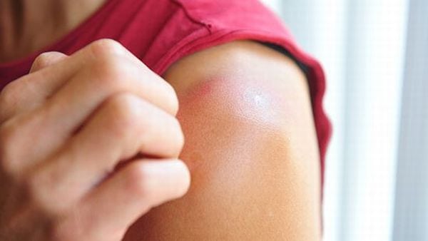 Protect Your Skin from Sunburn | How to Protect your skin from SUNBURN